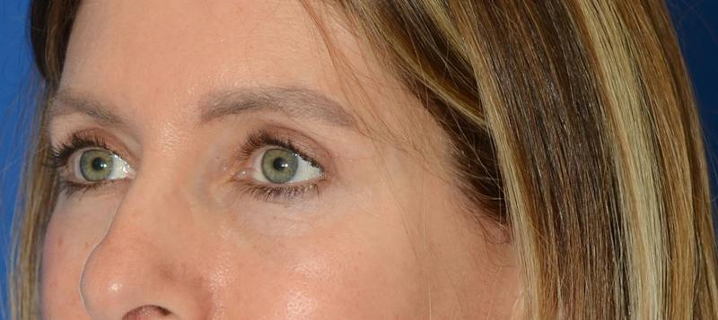 Blepharoplasty Before & After Gallery - Patient 335083 - Image 4