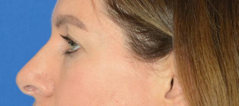 Blepharoplasty Before & After Gallery - Patient 335083 - Image 5