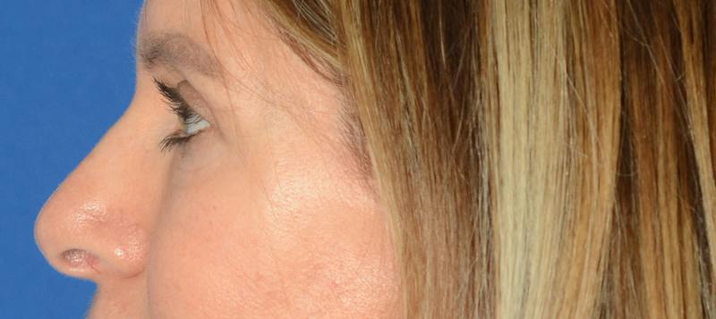 Blepharoplasty Before & After Gallery - Patient 335083 - Image 6