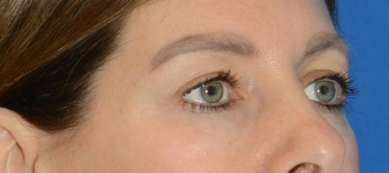 Blepharoplasty Before & After Gallery - Patient 335083 - Image 7