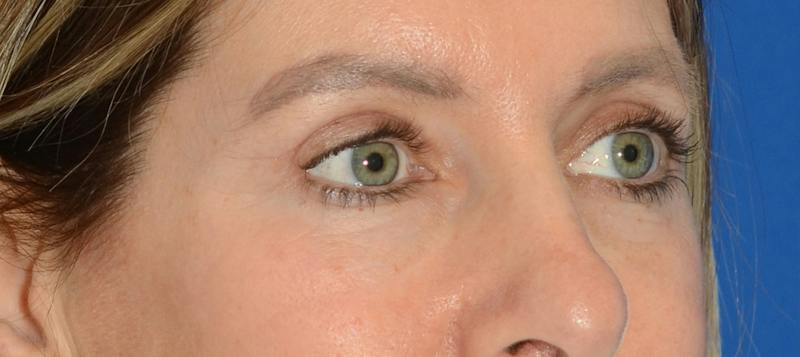 Blepharoplasty Before & After Gallery - Patient 335083 - Image 8