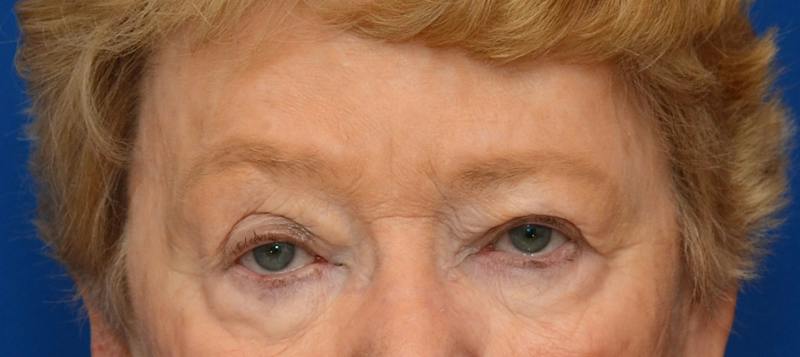 Blepharoplasty Before & After Gallery - Patient 112105 - Image 1