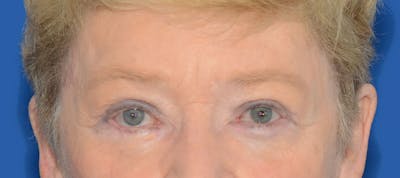 Blepharoplasty Before & After Gallery - Patient 112105 - Image 2
