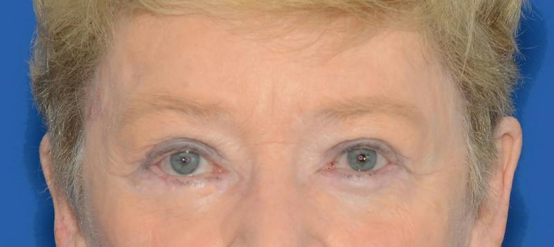 Blepharoplasty Before & After Gallery - Patient 112105 - Image 2