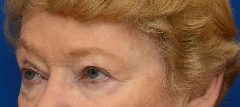 Blepharoplasty Before & After Gallery - Patient 112105 - Image 3
