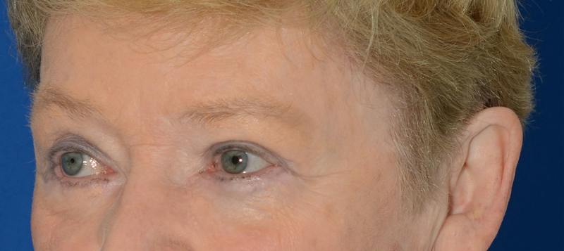 Blepharoplasty Before & After Gallery - Patient 112105 - Image 4