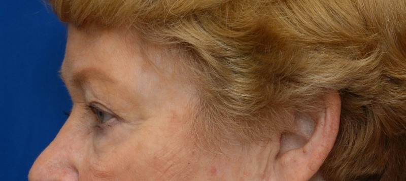 Blepharoplasty Before & After Gallery - Patient 112105 - Image 5