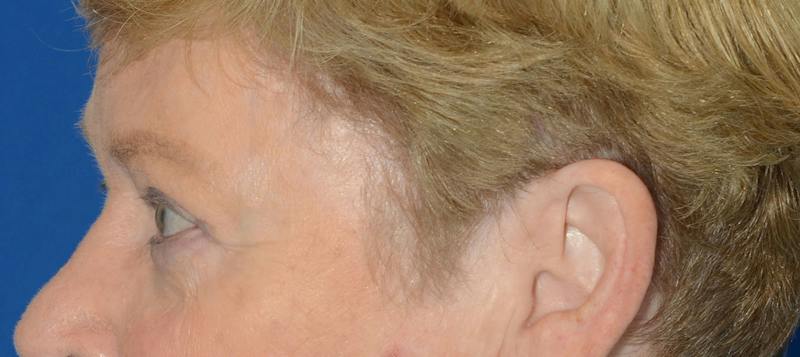 Blepharoplasty Before & After Gallery - Patient 112105 - Image 6