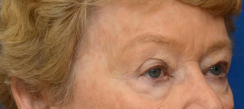 Blepharoplasty Before & After Gallery - Patient 112105 - Image 7