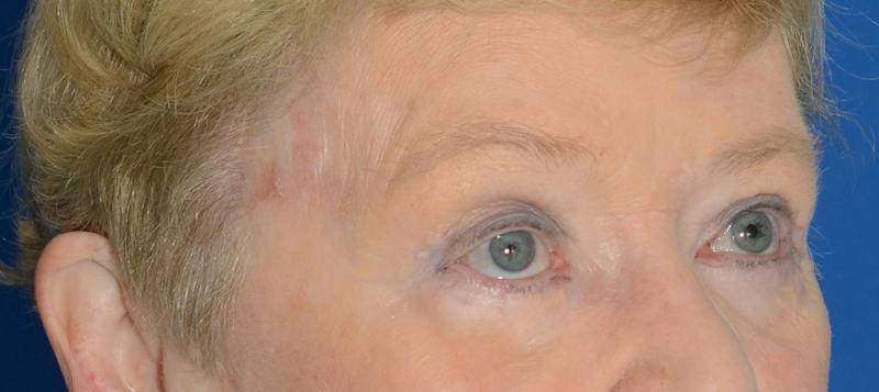 Blepharoplasty Before & After Gallery - Patient 112105 - Image 8