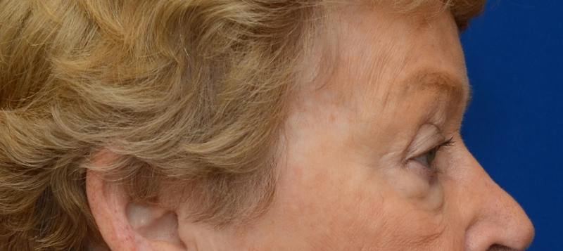 Blepharoplasty Before & After Gallery - Patient 112105 - Image 9