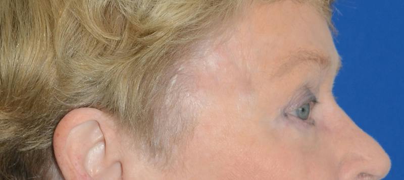 Blepharoplasty Before & After Gallery - Patient 112105 - Image 10