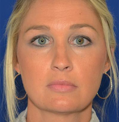 Rhinoplasty Before & After Gallery - Patient 256922 - Image 1