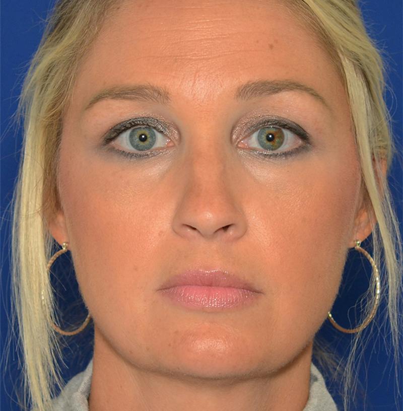 Rhinoplasty Before & After Gallery - Patient 256922 - Image 1