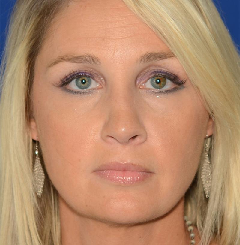 Rhinoplasty Before & After Gallery - Patient 256922 - Image 2
