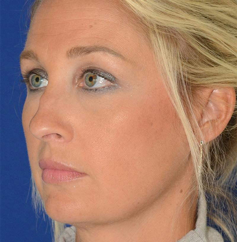 Rhinoplasty Before & After Gallery - Patient 256922 - Image 3