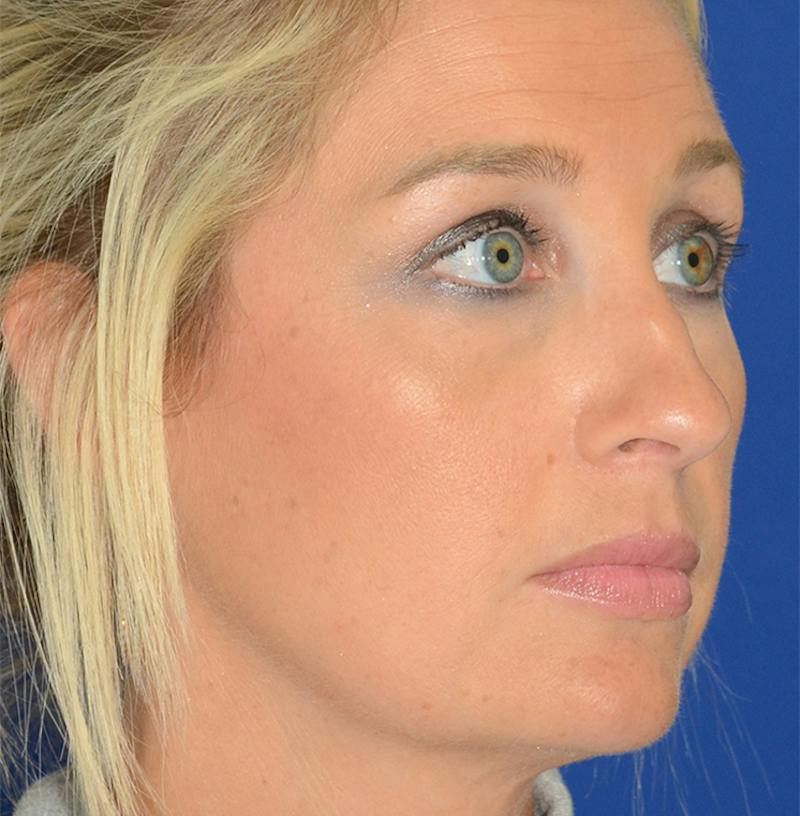 Rhinoplasty Before & After Gallery - Patient 256922 - Image 5