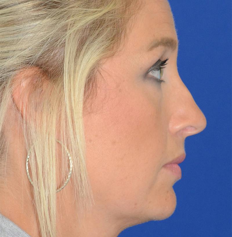 Rhinoplasty Before & After Gallery - Patient 256922 - Image 7