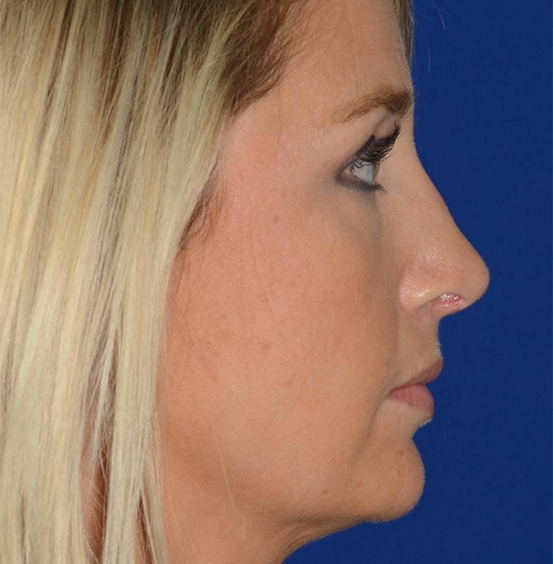 Rhinoplasty Before & After Gallery - Patient 256922 - Image 8