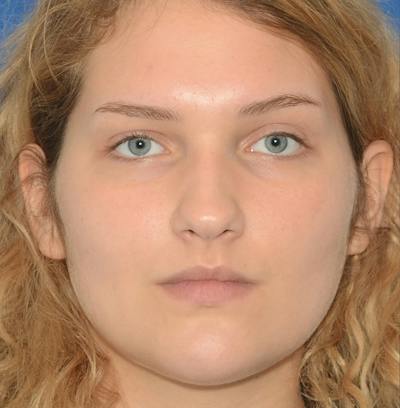 Rhinoplasty Before & After Gallery - Patient 303557 - Image 1