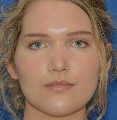 Rhinoplasty Before & After Gallery - Patient 303557 - Image 2