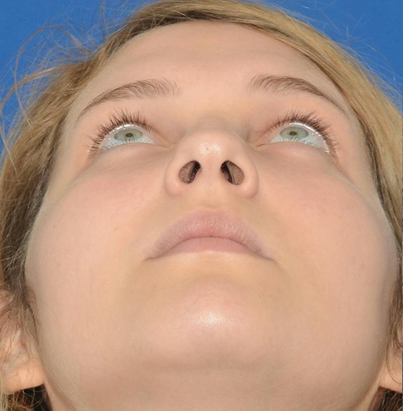 Rhinoplasty Before & After Gallery - Patient 303557 - Image 3