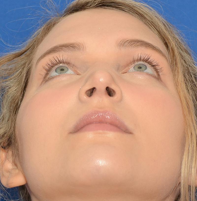 Rhinoplasty Before & After Gallery - Patient 303557 - Image 4
