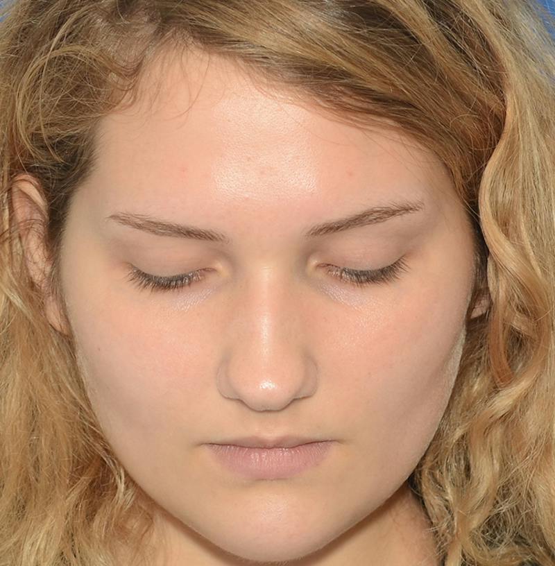 Rhinoplasty Before & After Gallery - Patient 303557 - Image 5
