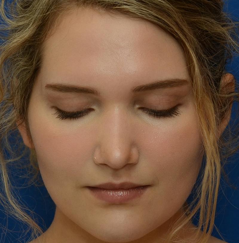 Rhinoplasty Before & After Gallery - Patient 303557 - Image 6