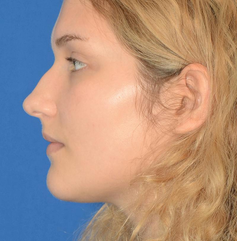 Rhinoplasty Before & After Gallery - Patient 303557 - Image 7
