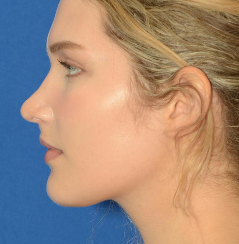 Rhinoplasty Before & After Gallery - Patient 303557 - Image 8