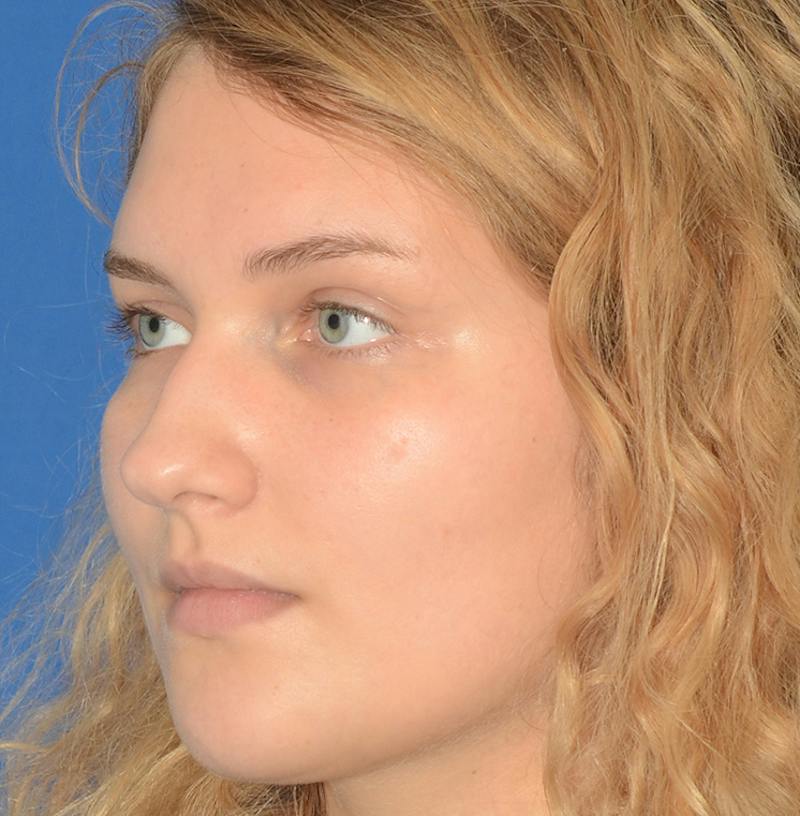 Rhinoplasty Before & After Gallery - Patient 303557 - Image 9