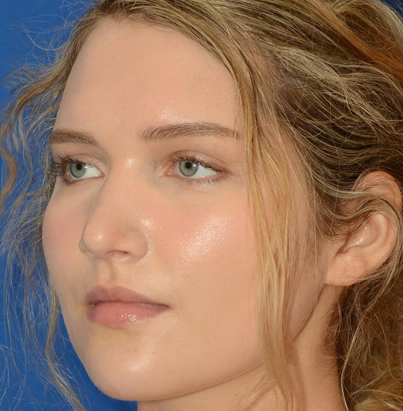 Rhinoplasty Before & After Gallery - Patient 303557 - Image 10
