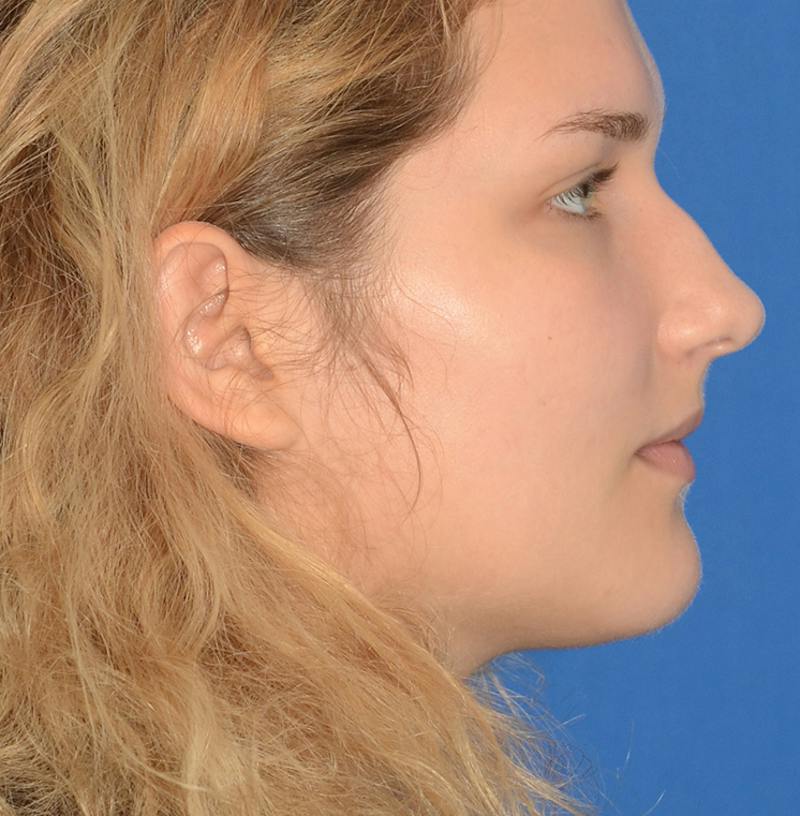 Rhinoplasty Before & After Gallery - Patient 303557 - Image 11