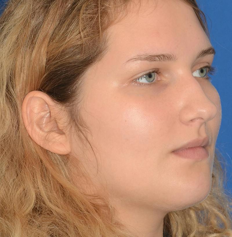 Rhinoplasty Before & After Gallery - Patient 303557 - Image 13