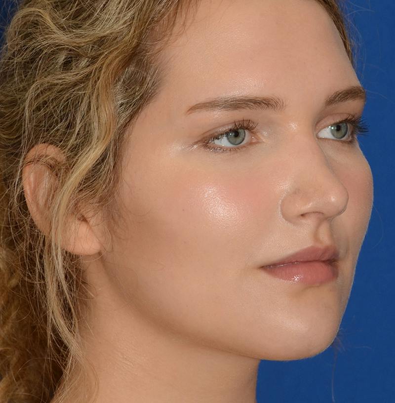 Rhinoplasty Before & After Gallery - Patient 303557 - Image 14
