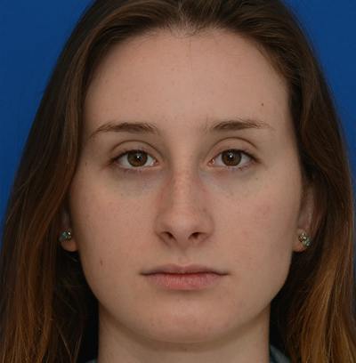 Rhinoplasty Before & After Gallery - Patient 293642 - Image 1
