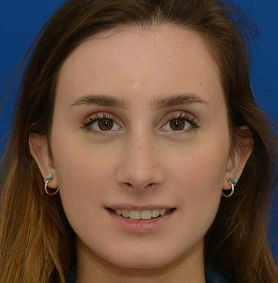 Rhinoplasty Before & After Gallery - Patient 293642 - Image 2