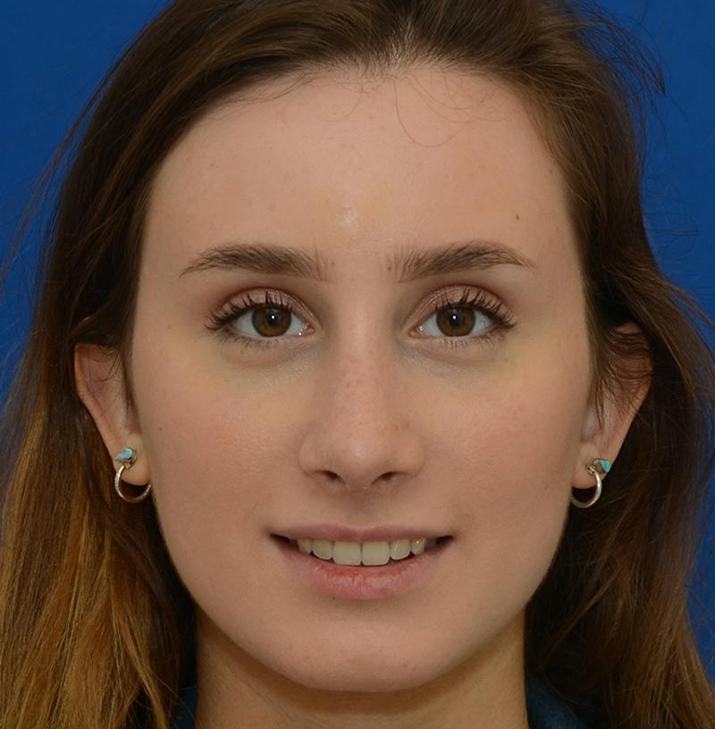 Rhinoplasty Before & After Gallery - Patient 293642 - Image 2