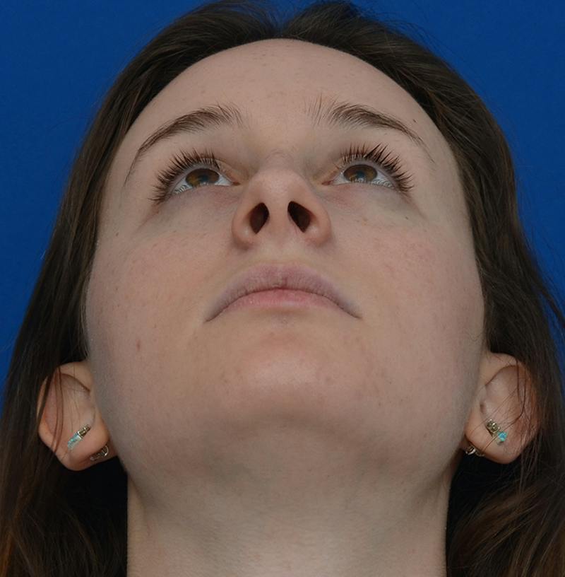 Rhinoplasty Before & After Gallery - Patient 293642 - Image 3