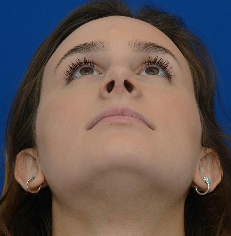 Rhinoplasty Before & After Gallery - Patient 293642 - Image 4