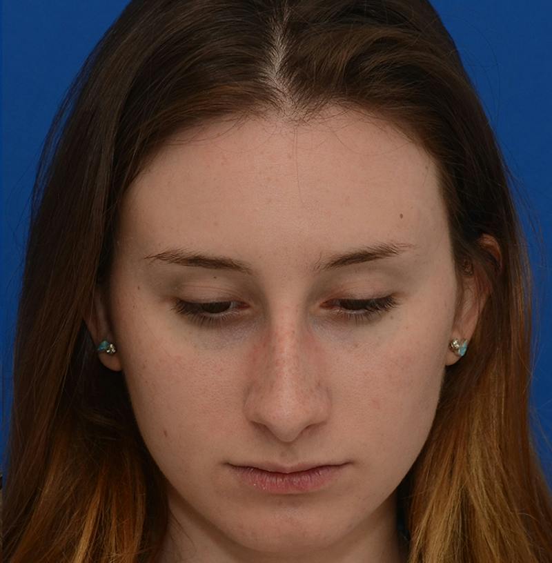 Rhinoplasty Before & After Gallery - Patient 293642 - Image 5