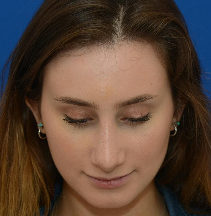 Rhinoplasty Before & After Gallery - Patient 293642 - Image 6