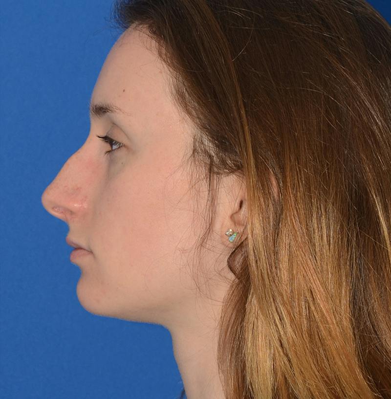 Rhinoplasty Before & After Gallery - Patient 293642 - Image 7