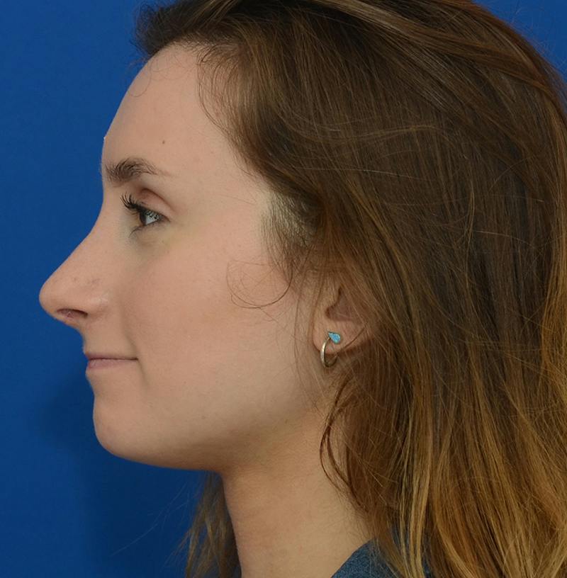 Rhinoplasty Before & After Gallery - Patient 293642 - Image 8