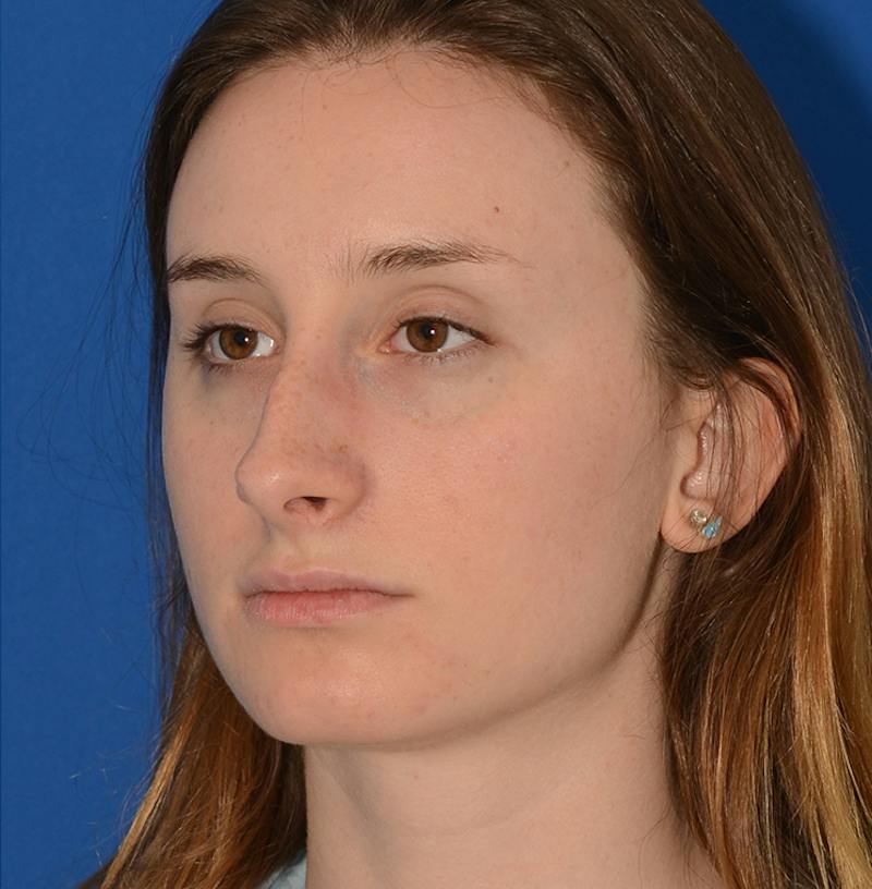 Rhinoplasty Before & After Gallery - Patient 293642 - Image 9