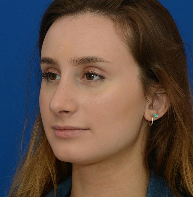 Rhinoplasty Before & After Gallery - Patient 293642 - Image 10