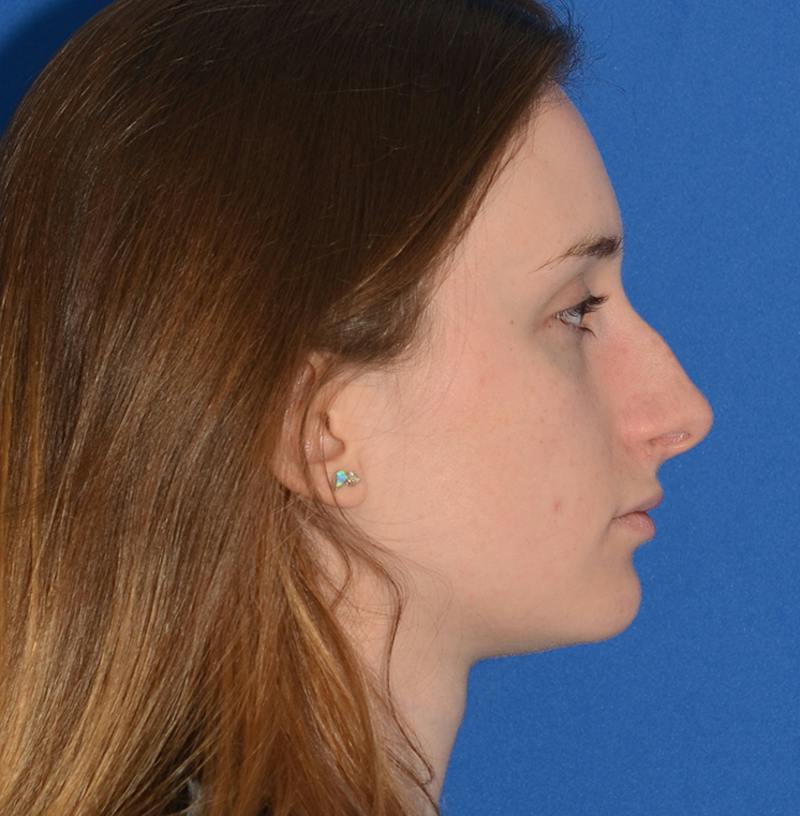 Rhinoplasty Before & After Gallery - Patient 293642 - Image 11