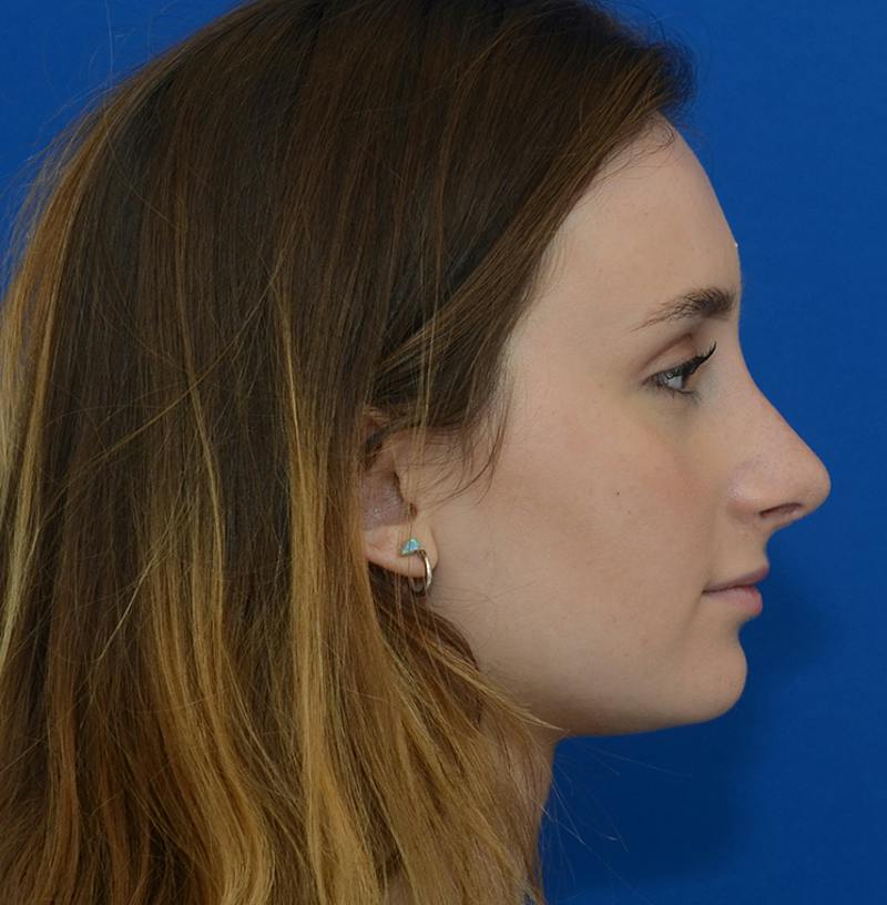 Rhinoplasty Before & After Gallery - Patient 293642 - Image 12