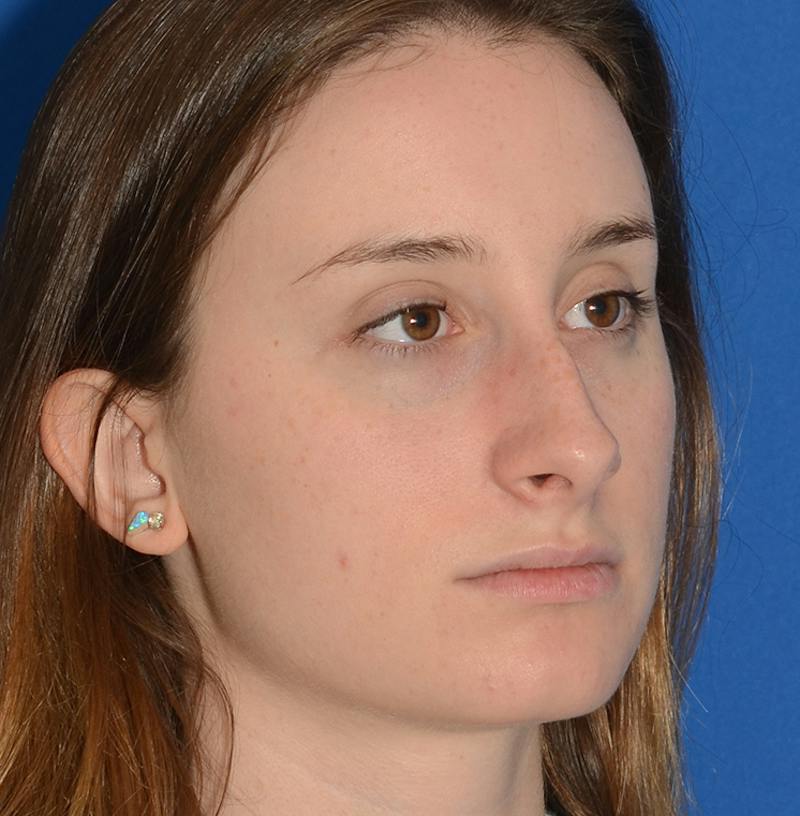 Rhinoplasty Before & After Gallery - Patient 293642 - Image 13